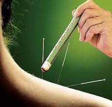 Acupuntura